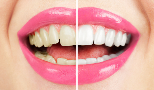 3 Types Of Tooth Stains And How To Fix Them Call Today 855 614 5221