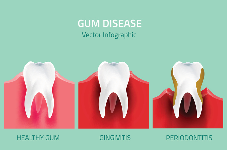 Gingivitis vs Periodontitis: What’s the Difference? - Call Today 855 ...