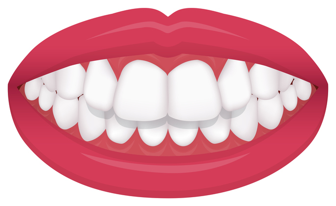 Overbite and Underbite Treatment in Los Angeles, CA - Misaligned teeth  Treatment