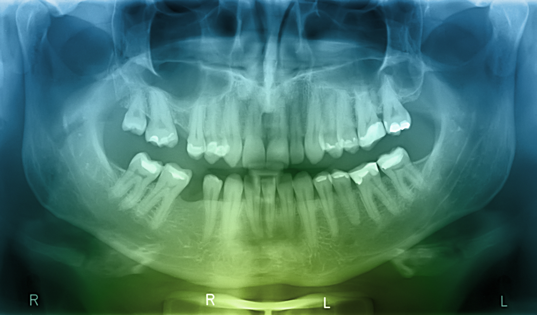 dental-x-rays-can-be-helpful-to-your-dentist-in-ways-you-might-not-have