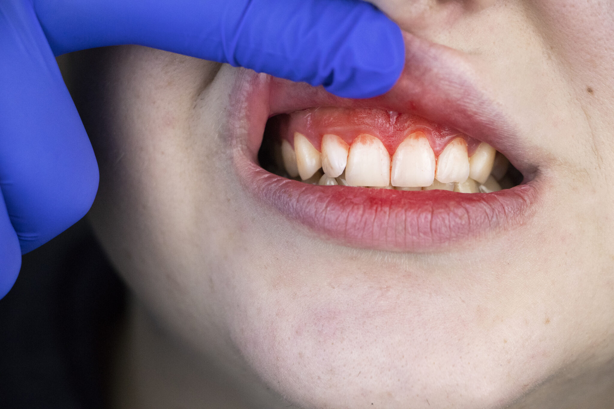 Five Reasons Behind Bleeding Gums During Teeth Brushing - Call Today ...