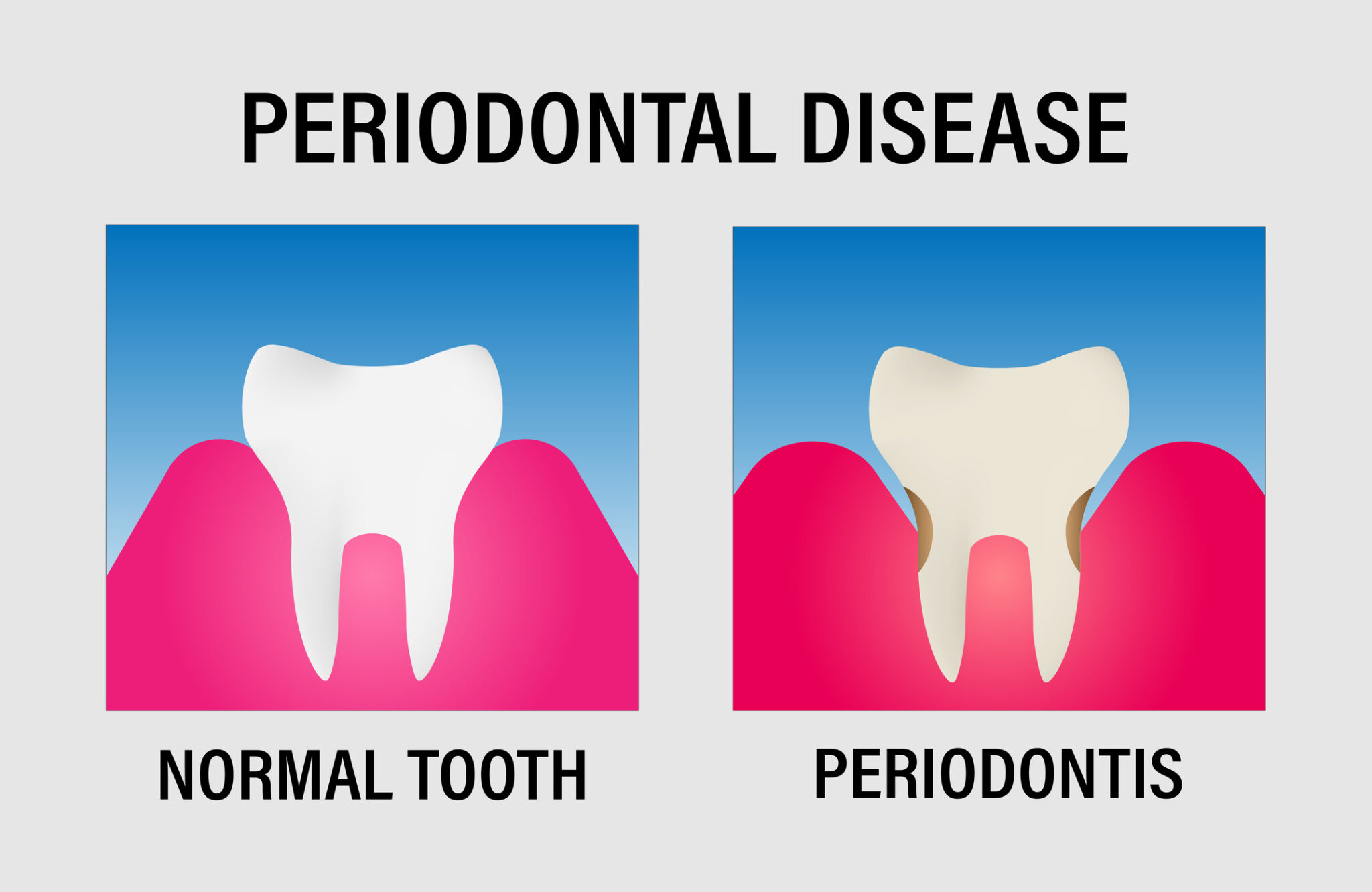 Gingivitis Vs Periodontitis: Understanding The Differences And 